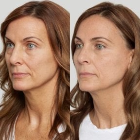 Результаты подтяжки нитями до и после в Plenary Wellness, омоложение лица