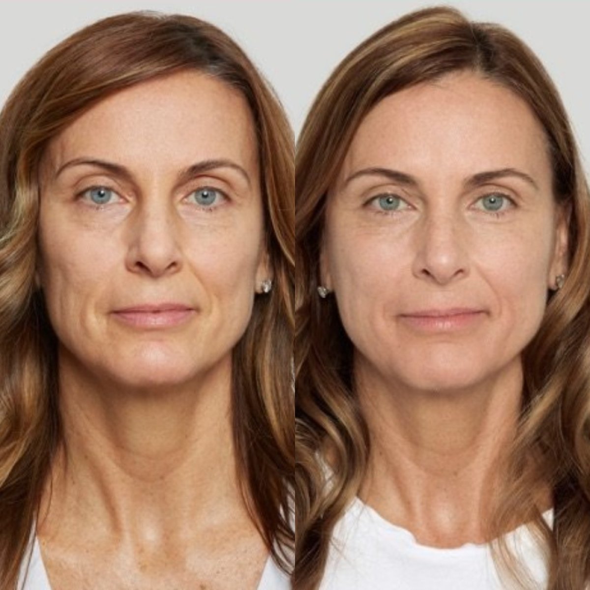 Résultats avant et après lifting par fils chez Plenary Wellness, rajeunissement du visage