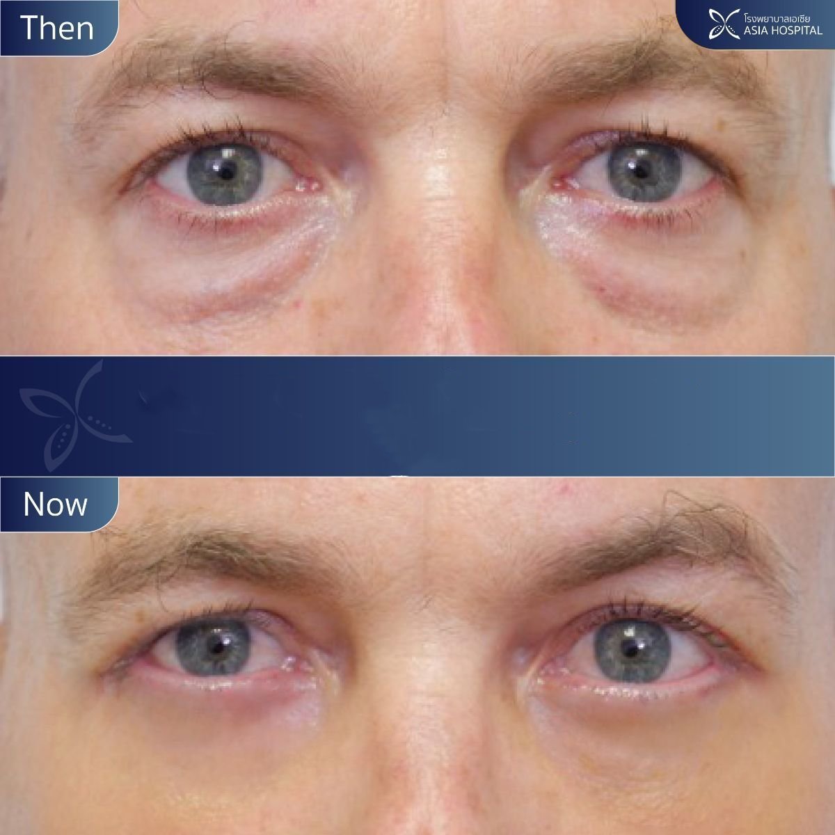 Результаты блефаропластики нижних век до и после в Asia Cosmetic Hospital, уменьшены мешки