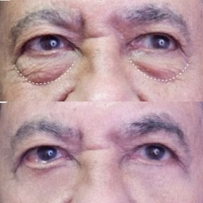 نتائج رأب الجفن السفلي قبل وبعد في Asia Cosmetic Hospital، تقليل انتفاخ تحت العين