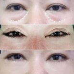 نتائج شد الجفن السفلي قبل وبعد في Asia Cosmetic Hospital، تقليل الانتفاخات تحت العين