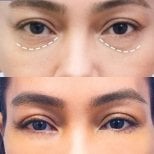 نتائج رأب الجفن السفلي قبل وبعد في Asia Cosmetic Hospital، تقليل انتفاخ تحت العين
