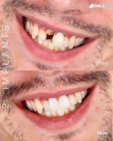 Antes y después de implantes dentales en Bookimed, sonrisa restaurada con resultado natural