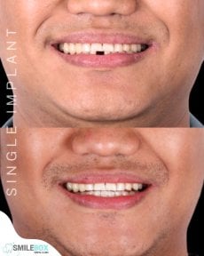 Resultados antes y después de implante dental único en SmileBox, restauración de diente frontal