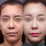 Результаты эндоскопической подтяжки лица до и после в Returning Plastic Surgery, омоложение