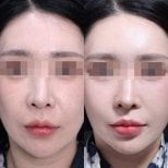 Результаты эндоскопической подтяжки лица до и после в Returning Plastic Surgery