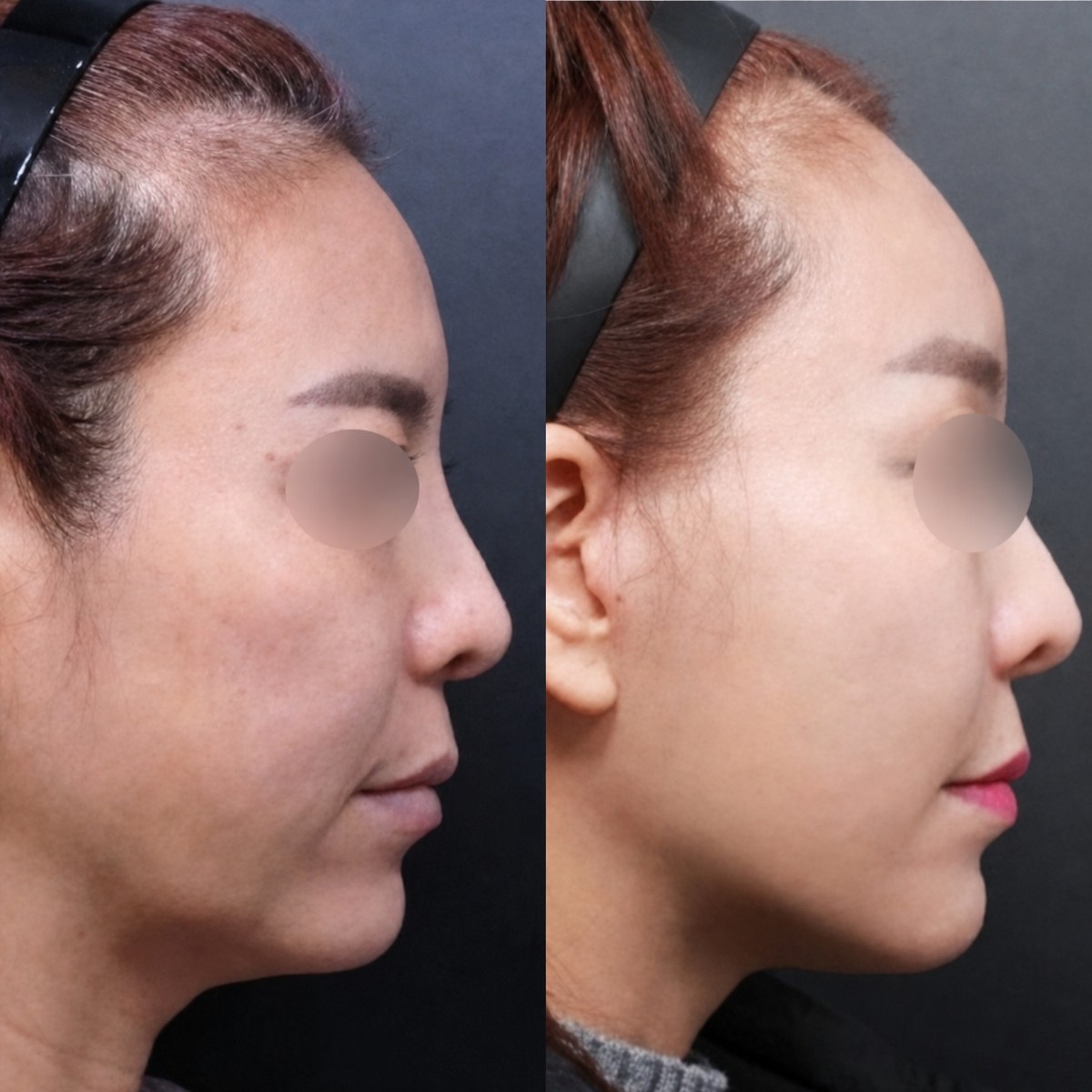 نتائج شد الوجه بالمنظار قبل وبعد في Returning Plastic Surgery، تجديد شباب الوجه