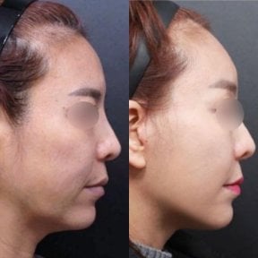 Результаты эндоскопической подтяжки лица до и после в Returning Plastic Surgery