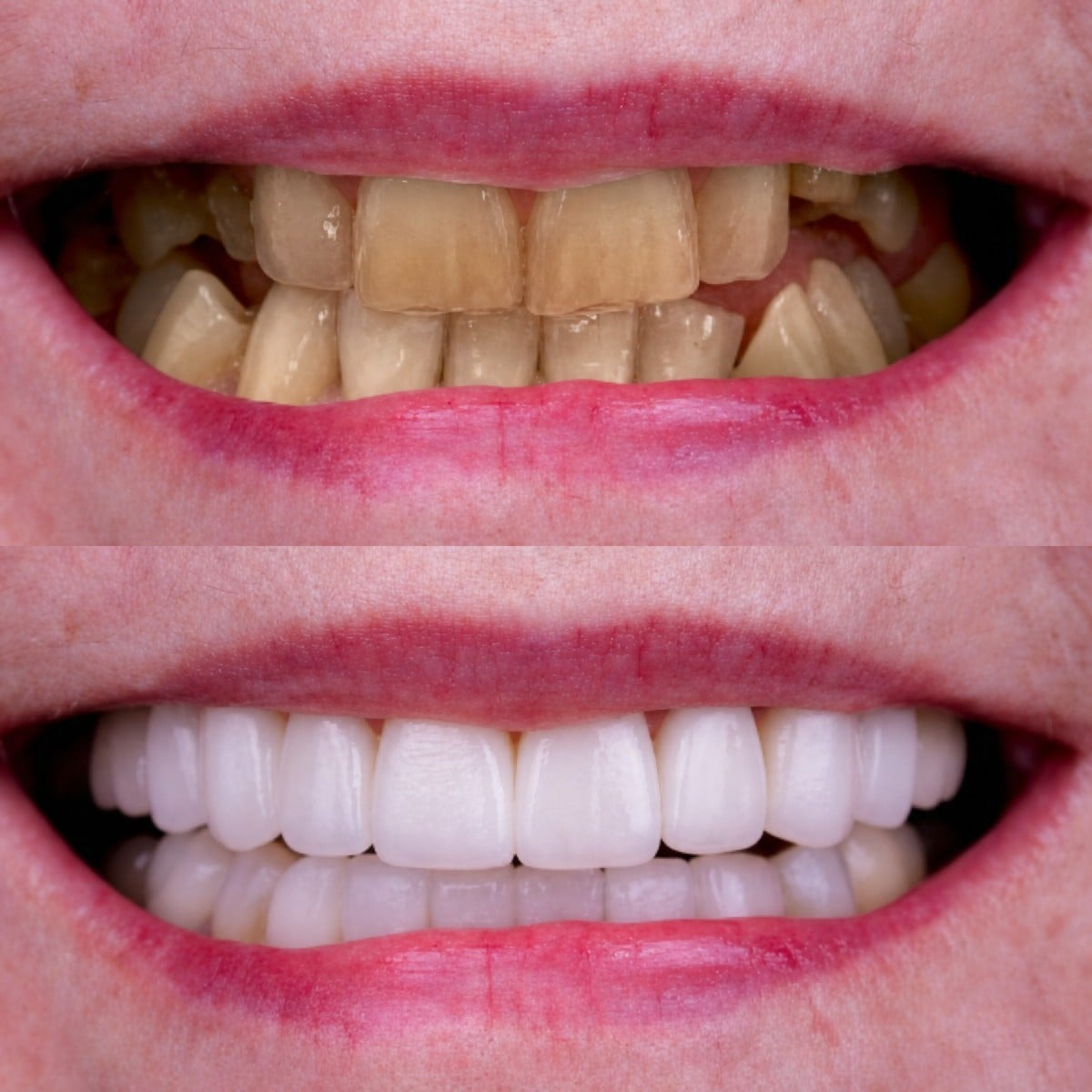 نتيجة قبل وبعد جسر الأسنان المدعوم بالزرعات في Excelentis Dental Center