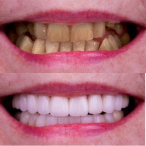 Vorher-nachher-Ergebnis einer Implantat-Brücke bei Excelentis Dental Center