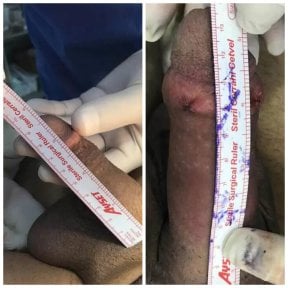 Before and after penis enlargement results at Quartz Hospital, visible length increase