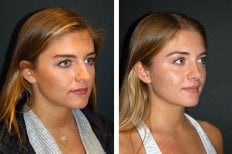 Resultados antes y después de eliminación de cicatrices con láser en Bookimed, piel mejorada