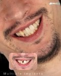 Résultat avant/après implants dentaires multiples chez SmileBox – sourire amélioré