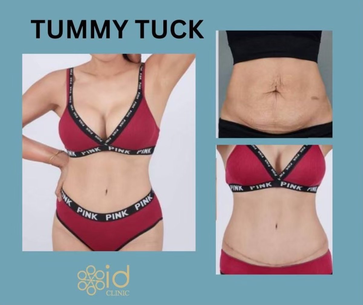 نتائج شد البطن قبل وبعد في ID Clinic Bangkok – تحسين واضح لشكل البطن