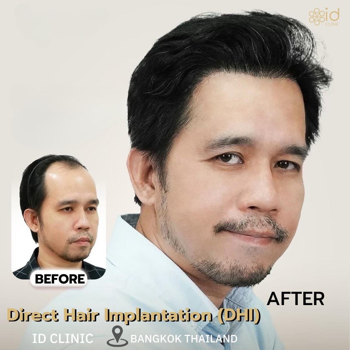 Результат пересадки волос DHI до и после в ID Clinic Bangkok – восстановленная линия волос
