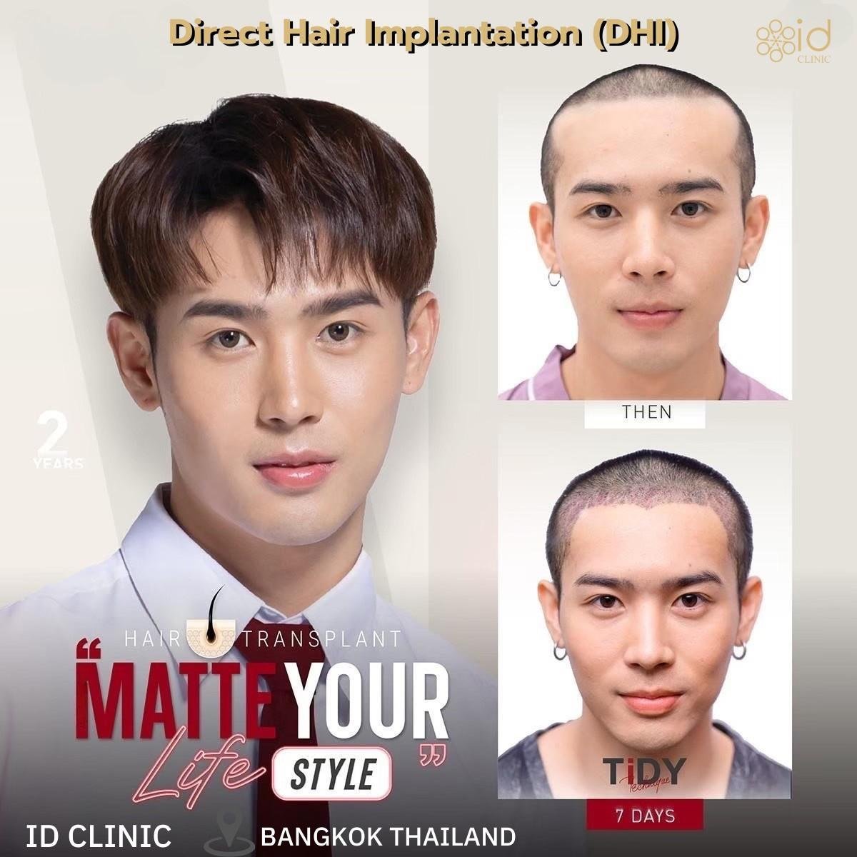 Результаты пересадки волос DHI в ID Clinic Bangkok – густая линия роста через 2 года