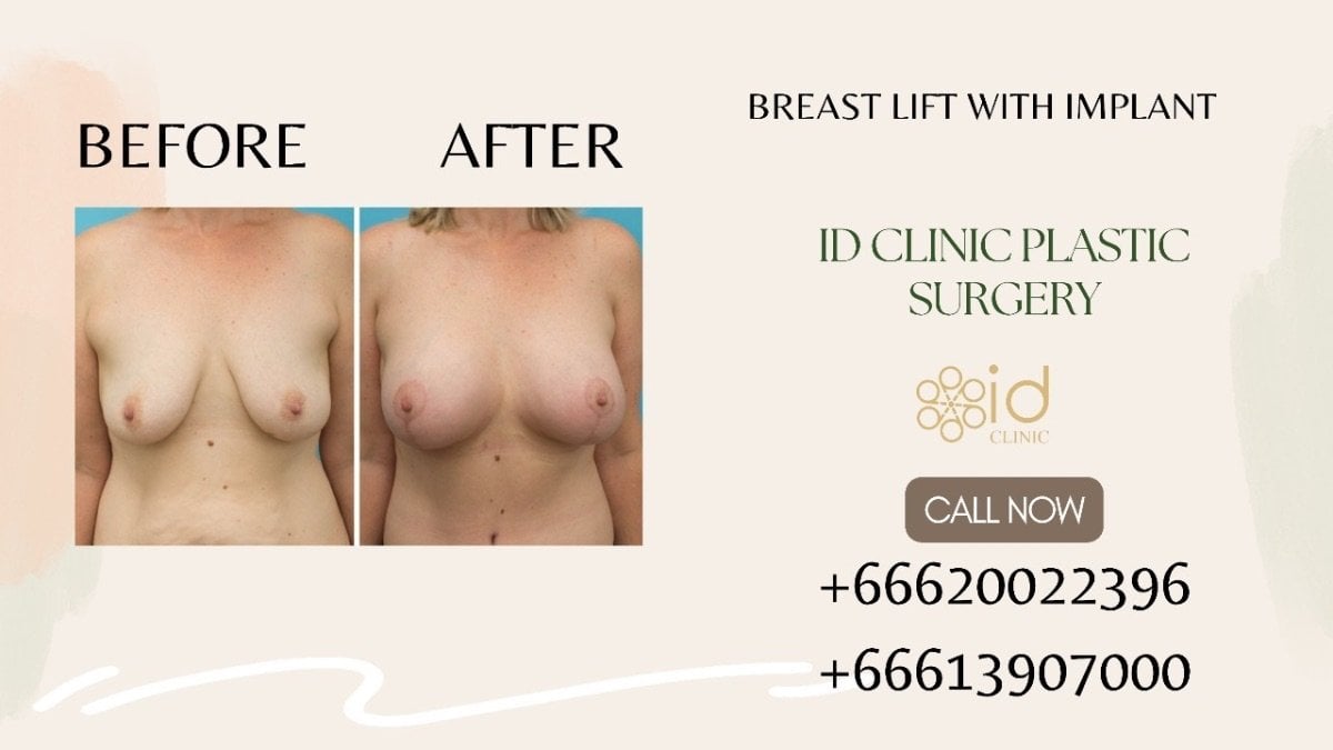 До и после подтяжки груди с имплантами в ID Clinic Bangkok, видимый результат коррекции