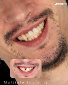 Przed i po wszczepieniu wielu implantów w SmileBox Dental Clinic, poprawiony uśmiech
