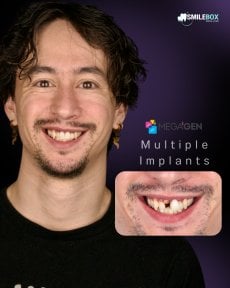Efekty implantów zębowych w SmileBox – przywrócony uśmiech, wiele implantów