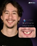 Efekty implantów zębowych w SmileBox – przywrócony uśmiech, wiele implantów
