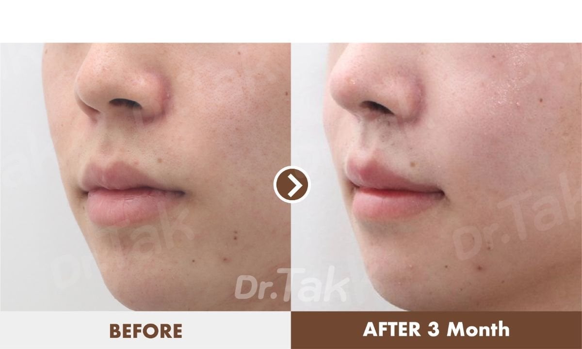 Resultados antes y después de reducción de labios en Dr. Tak Plastic Surgery, labios más delgados