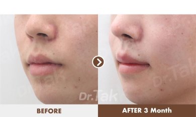 Before and after lip reduction results at Dr. Tak Plastic Surgery, visible slimmer lips