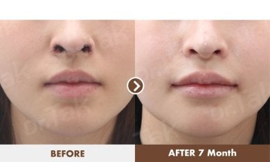 Before and after lip reduction results at Dr. Tak Plastic Surgery, 7 months post-procedure