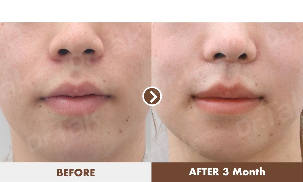 نتائج تصغير الشفاه قبل وبعد في عيادة Dr. Tak Plastic Surgery، شفاه أنحف بعد 3 أشهر