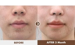 Before and after lip reduction results at Dr. Tak Plastic Surgery, visible slimmer lips after 3 months