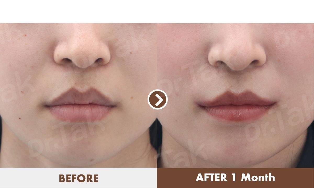 نتائج تصغير الشفاه قبل وبعد في عيادة Dr. Tak Plastic Surgery، شفاه أنحف بوضوح
