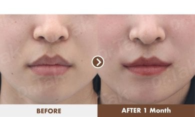 Before and after lip reduction results at Dr. Tak Plastic Surgery, visible slimmer lips outcome