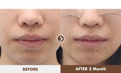Before and after lip reduction results at Dr. Tak Plastic Surgery, visible slimmer lips