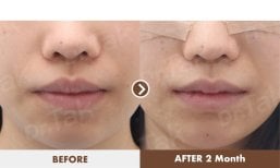Before and after lip reduction results at Dr. Tak Plastic Surgery, visible slimmer lips