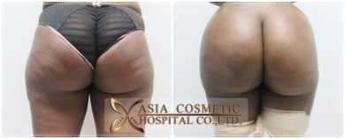 Resultados antes y después de Brazilian Butt Lift en Asia Cosmetic Hospital, glúteos realzados