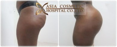 Resultados antes y después de Brazilian Butt Lift en Asia Cosmetic Hospital, glúteos realzados