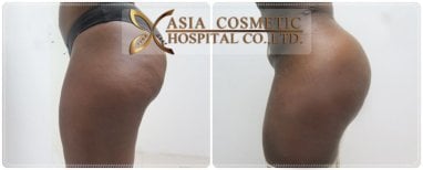 Resultados antes y después de Brazilian Butt Lift en Asia Cosmetic Hospital, glúteos realzados
