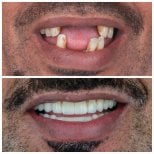 Результат до та після 4-імплантного протезу з CAD/CAM у Omara Dental Centers