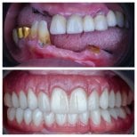 Результат до та після цирконієвих All-on-4 імплантів в Omara Dental Centers