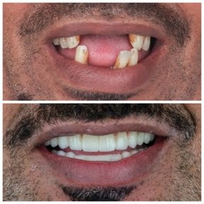 Результат до та після цирконієвих All-on-4 імплантів в Omara Dental Centers
