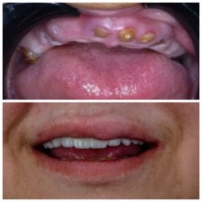Результат до та після цирконієвих All-on-4 імплантів в Omara Dental Centers