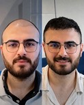 نتائج قبل وبعد زراعة الشعر FUE في Men's Health Clinics، استعادة خط الشعر للرجال