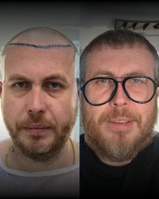 نتائج زراعة الشعر FUE قبل وبعد في Men's Health Clinics، استعادة خط الشعر الممتلئ