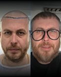 نتائج زراعة الشعر FUE قبل وبعد في Men's Health Clinics، استعادة خط الشعر الممتلئ