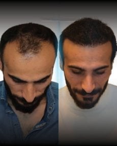 Before and after FUE hair transplant results at Men's Health Clinics, improved hair density
