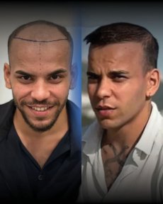 نتائج قبل وبعد زراعة الشعر FUE في Men's Health Clinics، استعادة خط الشعر للرجال