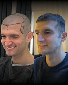 نتائج قبل وبعد زراعة الشعر بتقنية DHI في Men's Health Clinics، استعادة خط الشعر الطبيعي