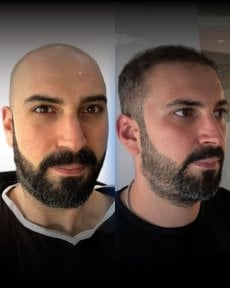 نتائج قبل وبعد زراعة الشعر DHI في Men's Health Clinics، استعادة خط الشعر الطبيعي