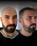 نتائج قبل وبعد زراعة الشعر DHI في Men's Health Clinics، استعادة خط الشعر الطبيعي