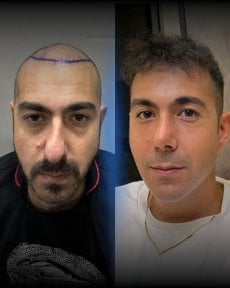 نتائج قبل وبعد زراعة الشعر DHI في Men's Health Clinics، استعادة خط الشعر للرجال