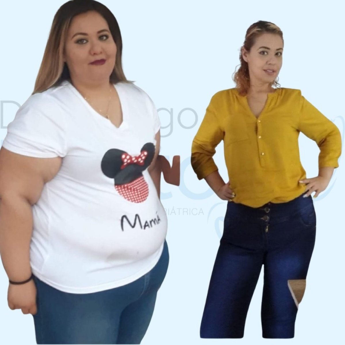 Resultados antes y después de bypass gástrico Roux-en-Y en Dr. Rodrigo Prieto Bariatric Center